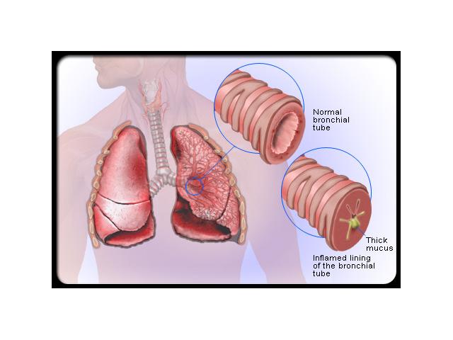 how lengthy is acute bronchitis contagious for