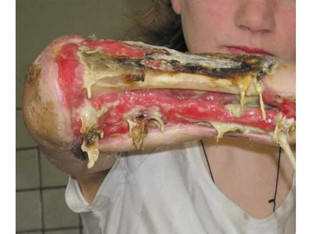 Diy Heroin Detox sheriff warns of deadly home made Diy Heroin Detox sheriff warns of deadly home made
